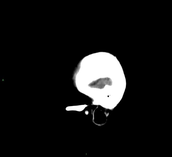 File:Cerebral amyloid angiopathy-associated lobar intracerebral hemorrhage (Radiopaedia 58530-65688 C 5).jpg