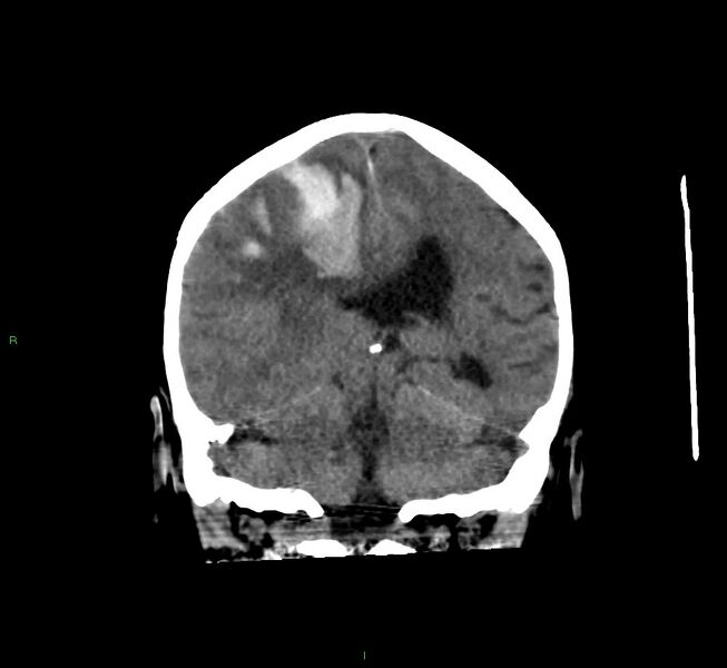 File:Cerebral amyloid angiopathy-associated lobar intracerebral hemorrhage (Radiopaedia 58560-65723 Coronal non-contrast 30).jpg