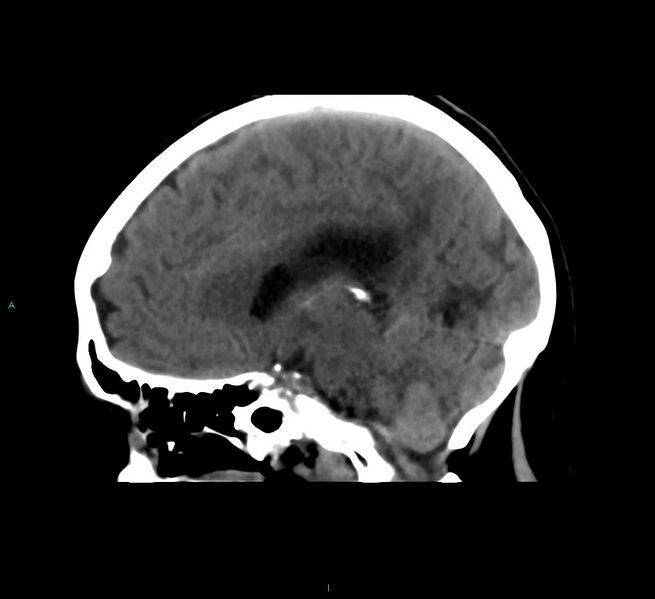 File:Cerebral amyloid angiopathy-associated lobar intracerebral hemorrhage (Radiopaedia 58561-65724 C 22).jpg