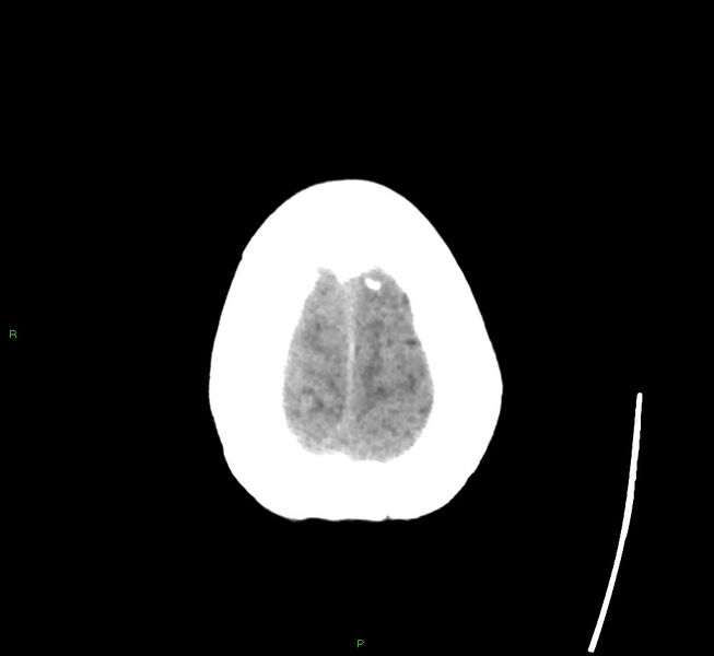 File:Cerebral amyloid angiopathy-associated lobar intracerebral hemorrhage (Radiopaedia 58563-65727 Axial non-contrast 9).jpg