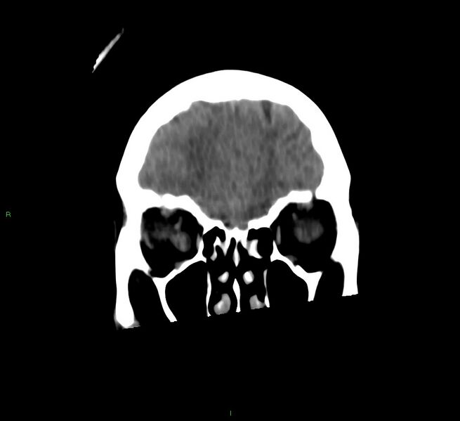 File:Cerebral amyloid angiopathy-associated lobar intracerebral hemorrhage (Radiopaedia 58566-65730 Coronal non-contrast 56).jpg