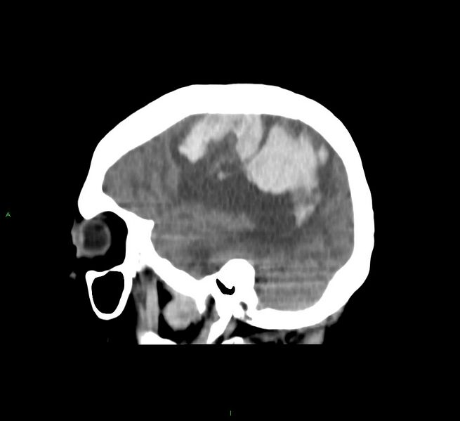 File:Cerebral amyloid angiopathy-associated lobar intracerebral hemorrhage (Radiopaedia 58751-65972 C 16).jpg