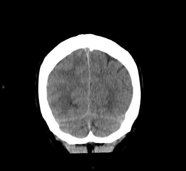 File:Cerebral amyloid angiopathy-associated lobar intracerebral hemorrhage (Radiopaedia 58756-65977 Coronal non-contrast 16).jpg