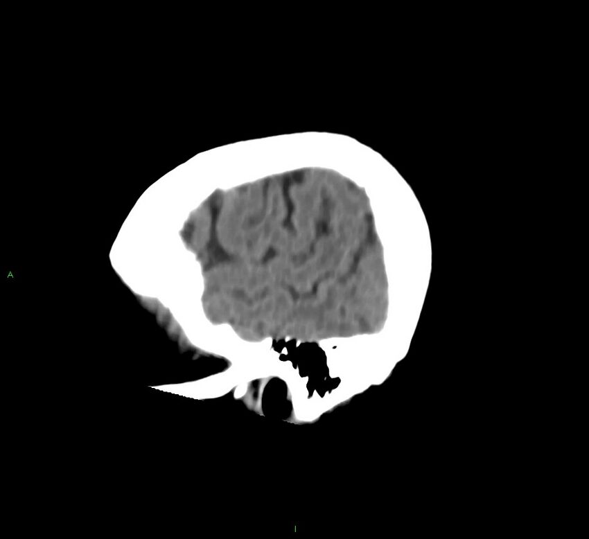 Cerebral amyloid angiopathy-associated lobar intracerebral hemorrhage (Radiopaedia 58757-65978 C 9).jpg