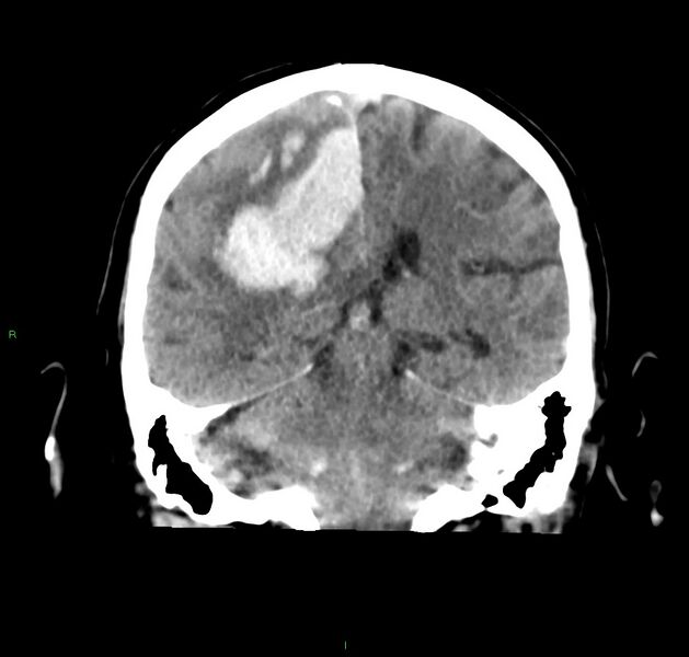 File:Cerebral amyloid angiopathy-associated lobar intracerebral hemorrhage (Radiopaedia 59356-66716 Coronal non-contrast 28).jpg