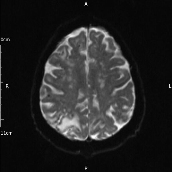 File:Cerebral amyloid angiopathy related inflammation (Radiopaedia 72772-83415 Axial DWI 17).jpg