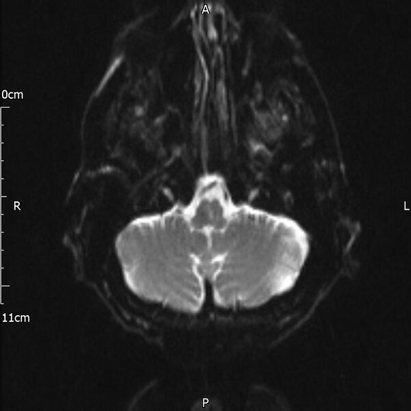 File:Cerebral amyloid angiopathy related inflammation (Radiopaedia 72772-83415 Axial DWI 5).jpg