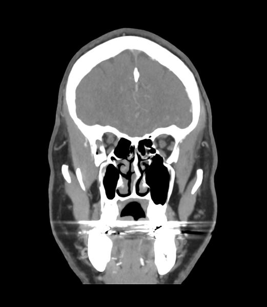 File:Cerebral dural venous sinus thrombosis (Radiopaedia 86514-102576 B 11).jpg