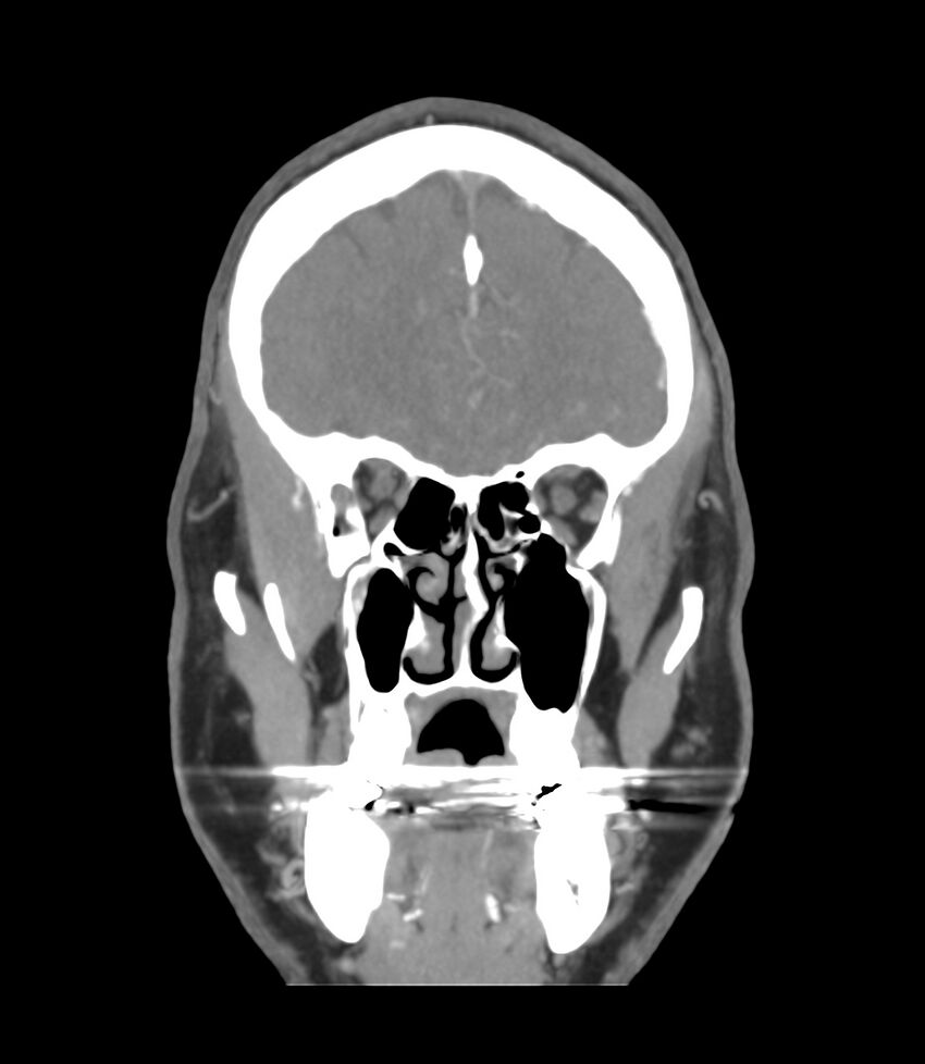 Cerebral dural venous sinus thrombosis (Radiopaedia 86514-102576 B 11).jpg