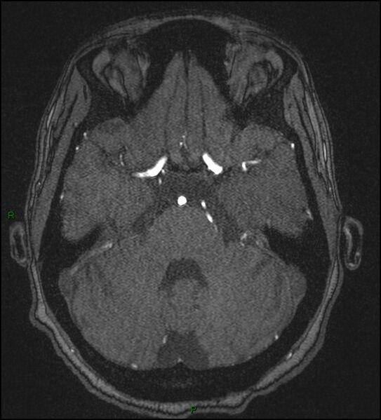 File:Cerebral fat embolism (Radiopaedia 35022-36525 Axial TOF 60).jpg