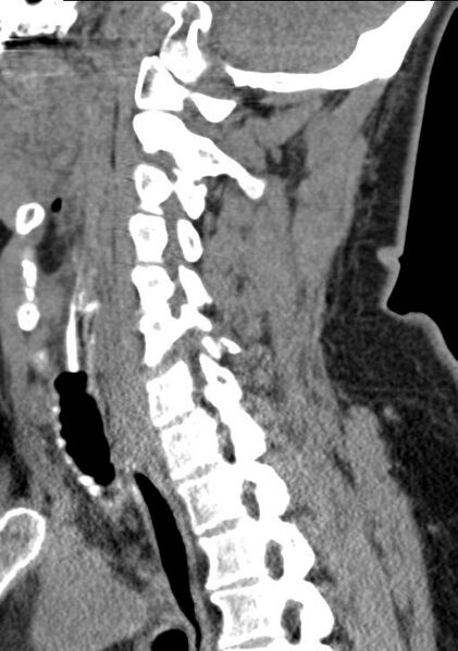 File:Cerebral hemorrhagic contusions and cervical spine fractures (Radiopaedia 32865-33841 G 51).jpg