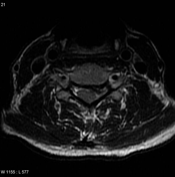 File:Cervical disc extrusion (Radiopaedia 5216-6982 Axial T2 5).jpg