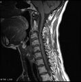 Cervical disc extrusion (Radiopaedia 5216-6982 Sagittal T1 4).jpg
