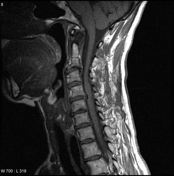 File:Cervical disc extrusion (Radiopaedia 5216-6982 Sagittal T1 4).jpg