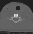 Cervical disc replacement (Radiopaedia 37383-39205 Axial bone window 12).png