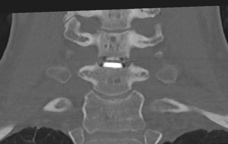 File:Cervical disc replacement (Radiopaedia 37383-39205 Coronal bone window 36).png