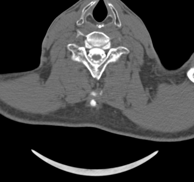 File:Cervical dural CSF leak on MRI and CT treated by blood patch (Radiopaedia 49748-54996 B 35).png