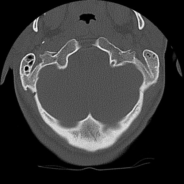 File:Cervical flexion teardrop fracture with cord hemorrhage (Radiopaedia 32497-33454 Axial bone window 8).jpg