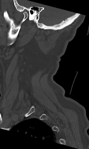 File:Cervical spine fracture - chalk stick (Radiopaedia 39116-41323 Sagittal bone window 54).png