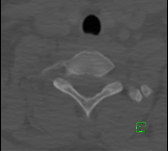 File:Cervical spine fracture - hyperflexion injury (Radiopaedia 66184-75364 Axial bone window 48).jpg