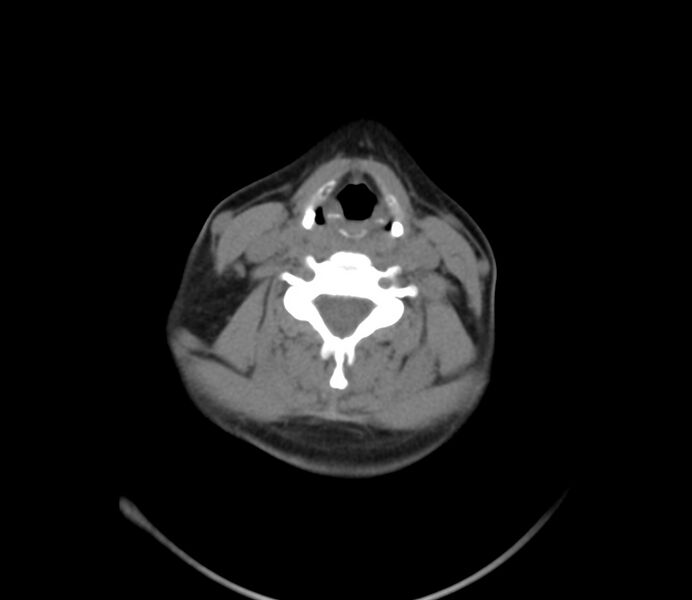 File:Cervical venous malformation (Radiopaedia 22653-22672 Axial non-contrast 35).jpg