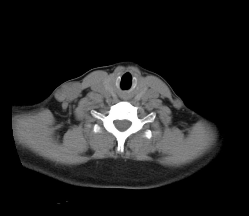 Cervical venous malformation (Radiopaedia 22653-22672 Axial non-contrast 41).jpg