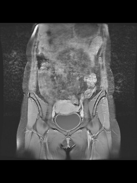 File:Cesarean section scar endometrioma (Radiopaedia 56569-63297 Coronal STIR 11).jpg
