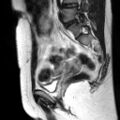 Cesarian section scar endometriosis (Radiopaedia 66520-75799 Sagittal T2 4).jpg