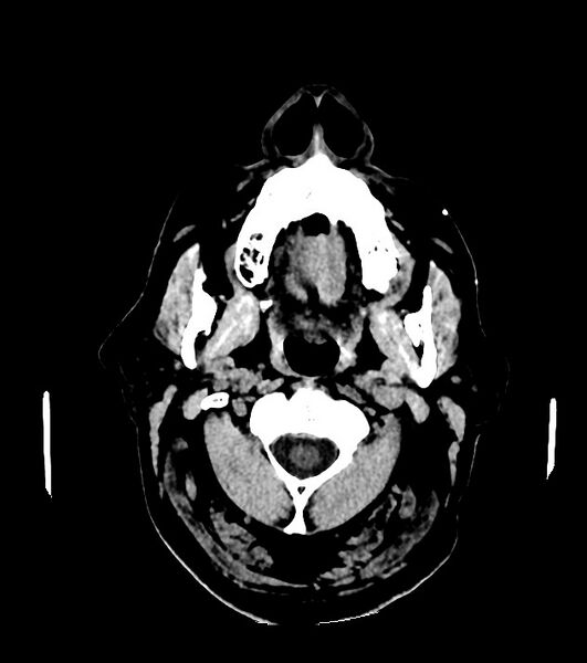 File:Cholangiocarcinoma with cerebral metastases (Radiopaedia 83519-98628 Axial non-contrast 2).jpg