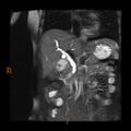 Cholelithiasis with biliary dilatation (Radiopaedia 49442-54589 Coronal T2 7).jpg