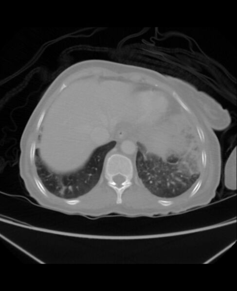 File:Chondrosarcoma (Radiopaedia 79427-92535 Axial lung window 44).jpg