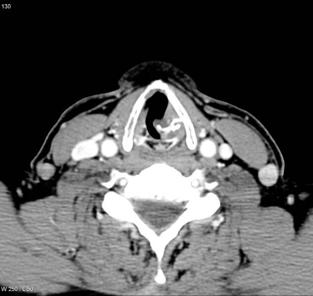 File:Chondrosarcoma - larynx (Radiopaedia 4588-6698 A 6).jpg