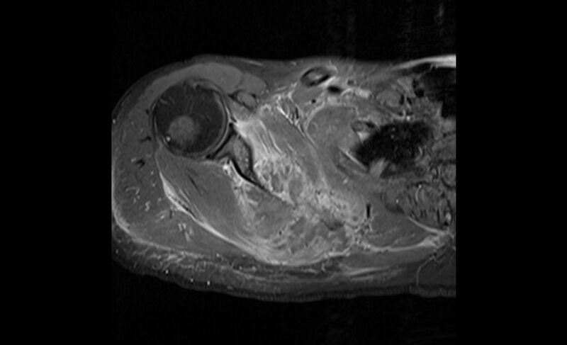 File:Choriocarcinoma in the shoulder (Radiopaedia 28603-28861 Axial T1 C+ fat sat 10).jpg