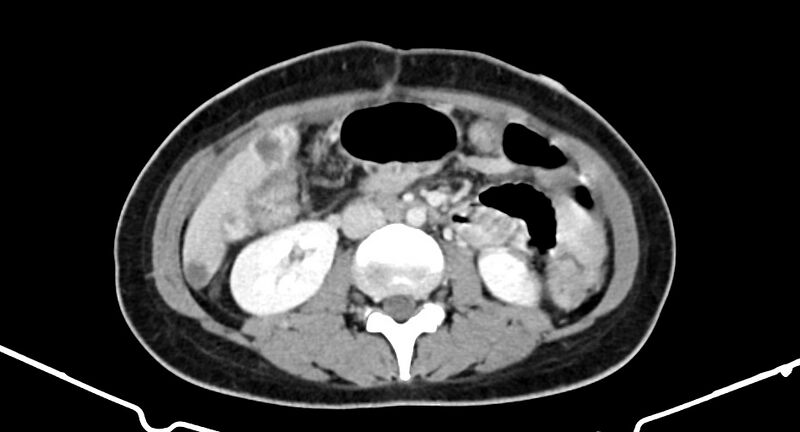 File:Choriocarcinoma liver metastases (Radiopaedia 74768-85766 A 110).jpg