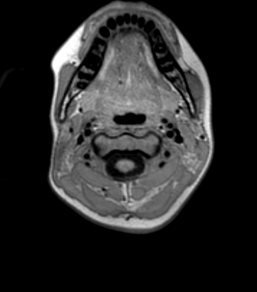 Choroid plexus carcinoma (Radiopaedia 91013-108553 Axial T1 1).jpg