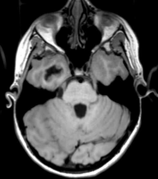 File:Choroid plexus carcinoma (Radiopaedia 91013-108553 Axial T1 59).jpg