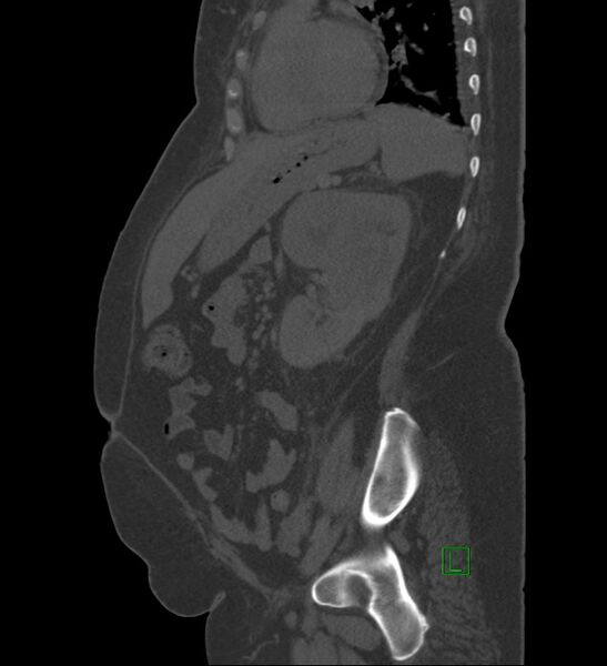 File:Chromophobe renal cell carcinoma (Radiopaedia 84239-99519 Sagittal bone window 35).jpg