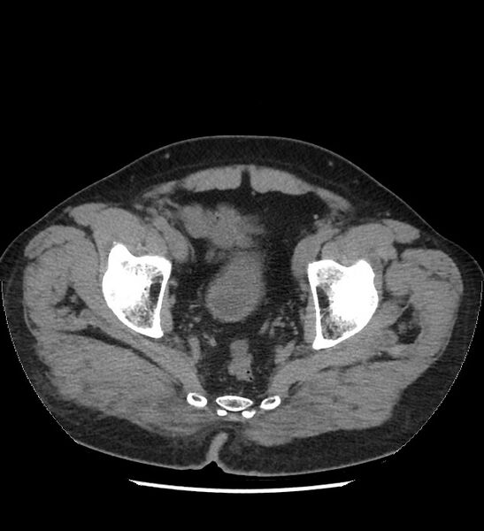 File:Chromophobe renal cell carcinoma (Radiopaedia 86879-103083 Axial non-contrast 117).jpg