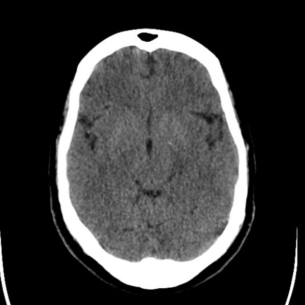 File:Chronic bilateral occipital lobe infarcts (Radiopaedia 31276-31996 Axial non-contrast 18).jpg