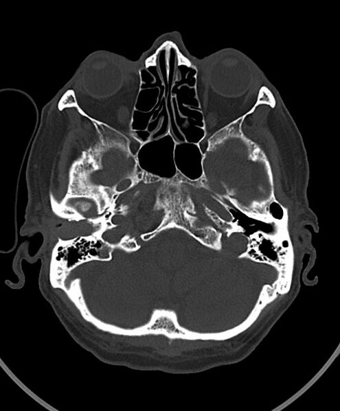 File:Chronic bilateral subdural hygroma (Radiopaedia 85801-101623 Axial bone window 97).jpg