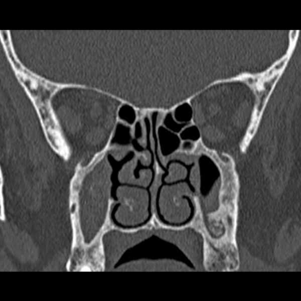 File:Chronic maxillary sinusitis (Radiopaedia 27879-28116 Coronal bone window 31).jpg