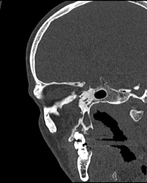 File:Chronic maxillary sinusitis caused by a foreign body (Radiopaedia 58521-65676 Sagittal bone window 56).jpg