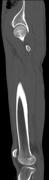 File:Chronic osteomyelitis (with sequestrum) (Radiopaedia 74813-85822 C 29).jpg