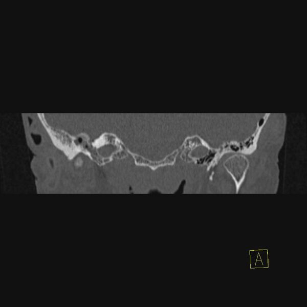 File:Chronic otitis media (Radiopaedia 14994-14912 Coronal bone window 17).JPEG