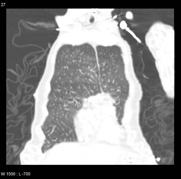 File:Clagett thoracotomy (Radiopaedia 8568-9403 Coronal lung window 27).jpg