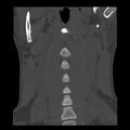 Clay-shoveler fracture (Radiopaedia 22568-22590 Coronal bone window 2).jpg