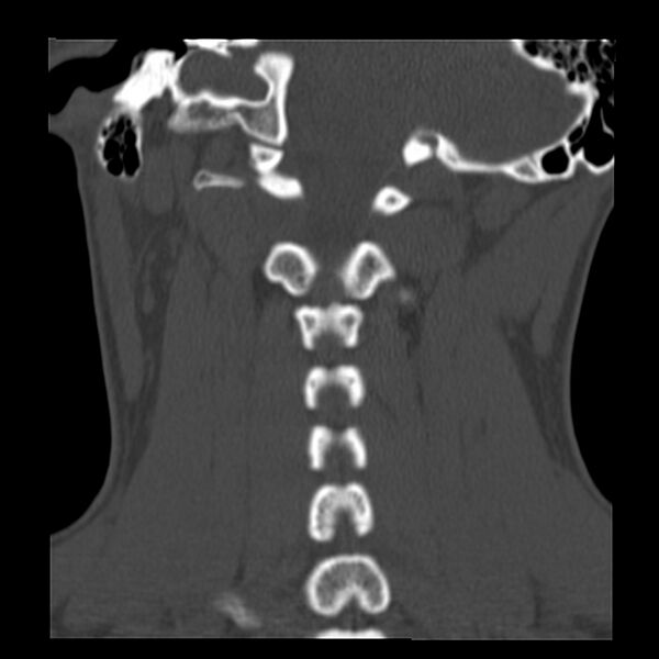 File:Clay-shoveler fracture (Radiopaedia 22568-22590 Coronal bone window 24).jpg