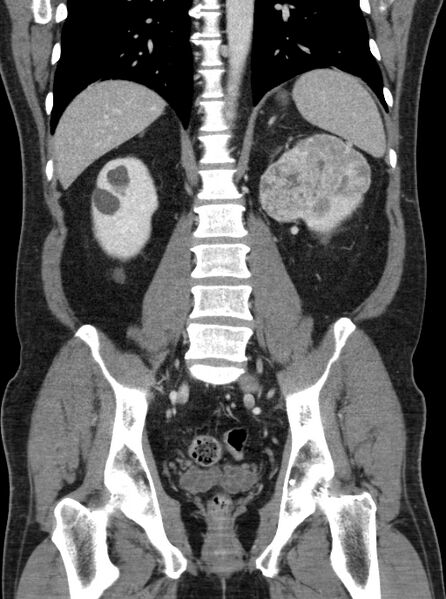 File:Clear cell renal cell carcinoma (Radiopaedia 61449-69393 F 33).jpg