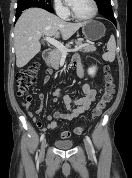 File:Clear cell renal cell carcinoma (Radiopaedia 61449-69393 F 5).jpg