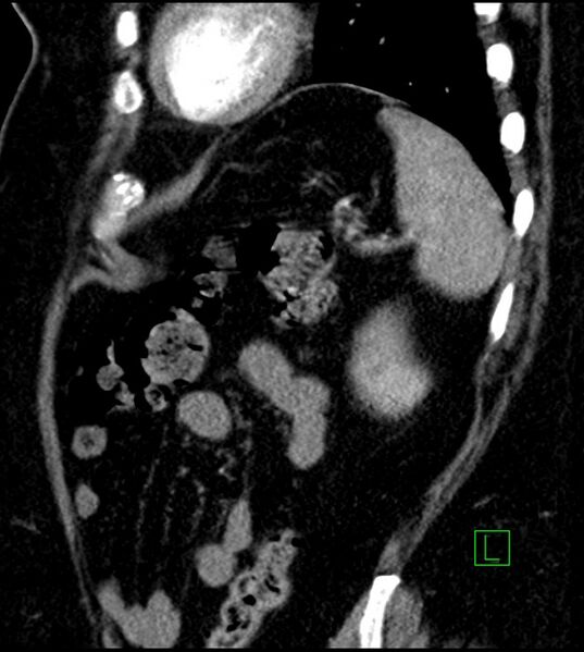 File:Clear cell renal cell carcinoma (Radiopaedia 85004-100537 D 14).jpg